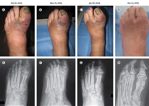 Non-surgical treatment of diabetic foot osteomyelitis - The Lancet ...