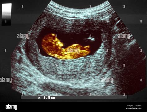 Nuchal translucency ultrasound scan 12 hi-res stock photography and images - Alamy