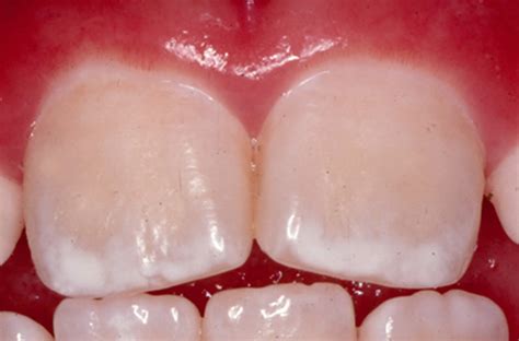 Dental fluorosis causes, prevention, symptoms & dental fluorosis treatment