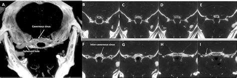 Axial computed tomography of the middle cranial fossa. Axial computed ...