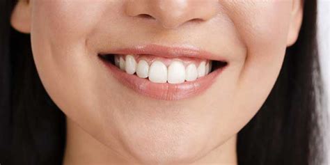 Composite Veneers Procedure, Cost, Benefits, Appointment