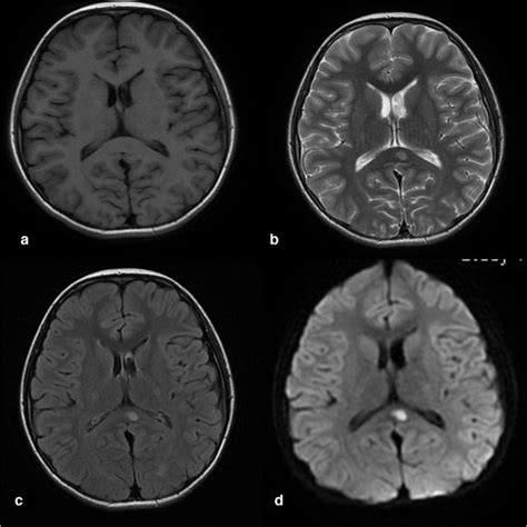 Cranial MRI revealed an isolated elliptic lesion in the splenium of the... | Download Scientific ...