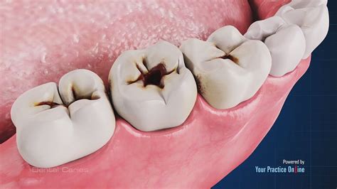 How to Prevent Dental Caries - Dental Clinic