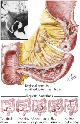 Small Intestine Diseases | Basicmedical Key