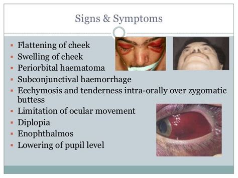 Zygomatic Complex Fracture- ZMC