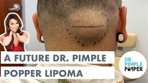 A Future Dr. Pimple Popper Lipoma - Dr. Pimple Popper