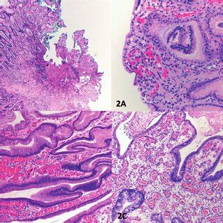 Foveolar hyperplasia score 2, the length of the foveolae is greater... | Download Scientific Diagram