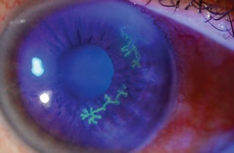 Approach to Corneal Disorders in the ED - CanadiEM