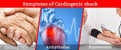 Cardiogenic Shock - Causes, Symptoms, Diagnosis, Treatment & Prevention