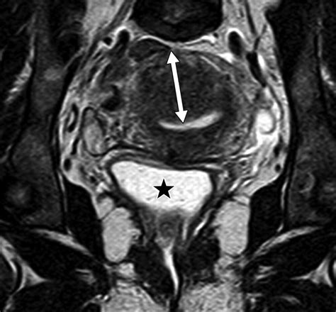 Retroflexed Uterus Mri