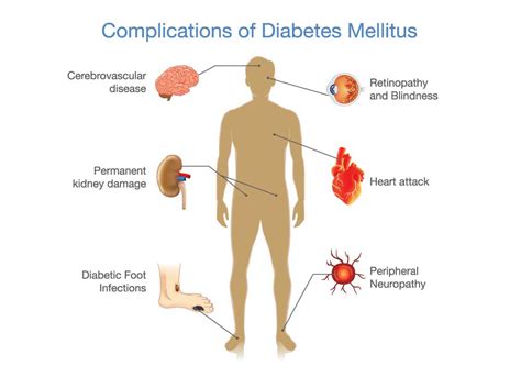 Complications of Type 2 Diabetes Mellitus - Check Now