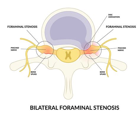 Bilateral Foraminal Stenosis | Bonati Spine Institute