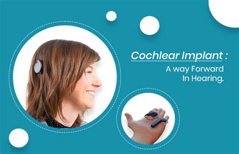 Cochlear Implant : A way Forward In Hearing. - Asha Speech and Hearing ...