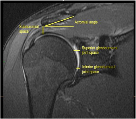 Axial traction magnetic resonance imaging (MRI) of the glenohumeral joint in healthy volunteers ...