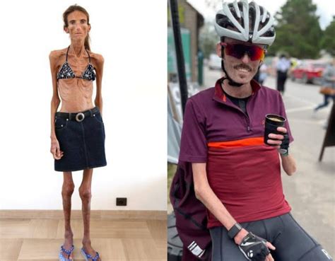 Skinniest Person: Meet 10 World's Thinnest People Alive 2024 - The Daily Nairobi