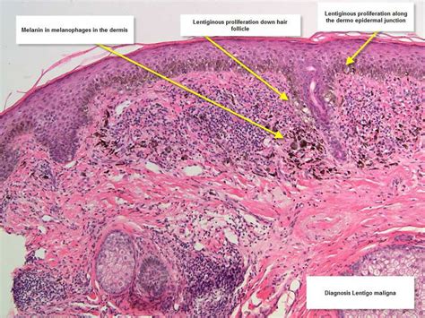 Consultations in Dermatology: The Black and Pink Spot - Melanoma