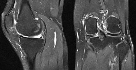 Meniscus Root Injury | MRI of the Knee - Robert LaPrade MD | Orthopedic Knee Specialist Sports ...