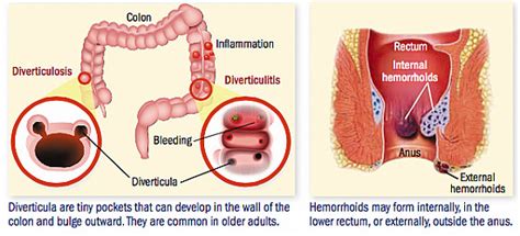 Hemorrhoids Bleeding