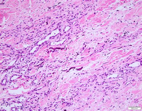 Pathology Outlines - Calciphylaxis