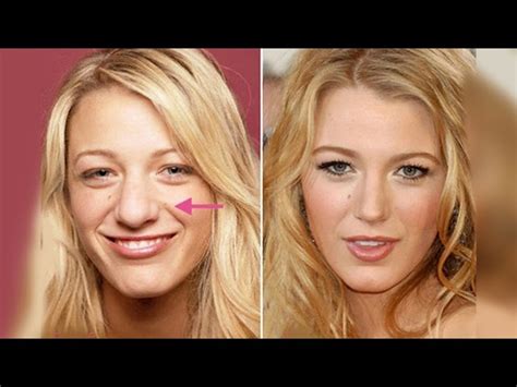 Quick Facts About Blake Lively’s Plastic Surgery Procedures in the Past ...