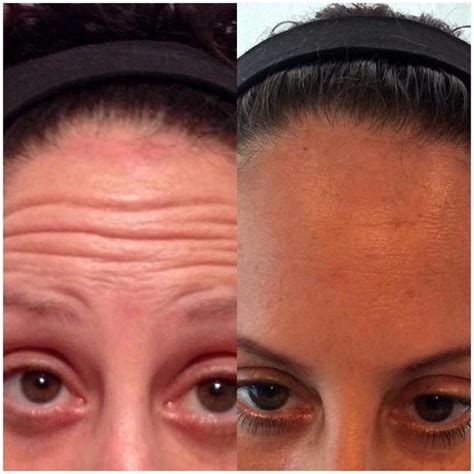 Botox Before And After Pictures Forehead (4) » Facelift: Info, Prices, Photos, Reviews, Q&A