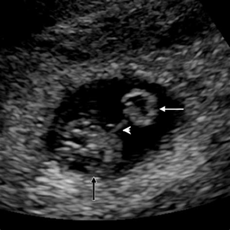 Sonographic Evaluation of the Yolk Sac - Tan - 2012 - Journal of Ultrasound in Medicine - Wiley ...