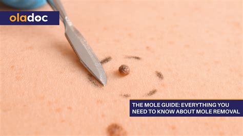 The Mole Guide: Everything You Need To Know About Mole Removal | Beauty and Skin Care | oladoc.com