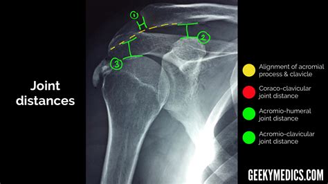 Shoulder X-ray Interpretation | Radiology | Geeky Medics