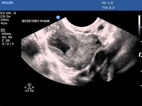 Transvaginal ultrasound of corpus luteum cyst (no color) - YouTube