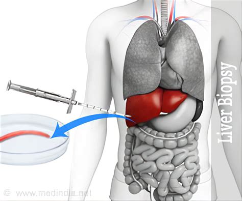 Liver Biopsy - References