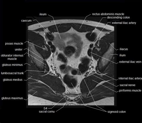 MRI pelvis Anatomy | Free Male Pelvis Axial Anatomy