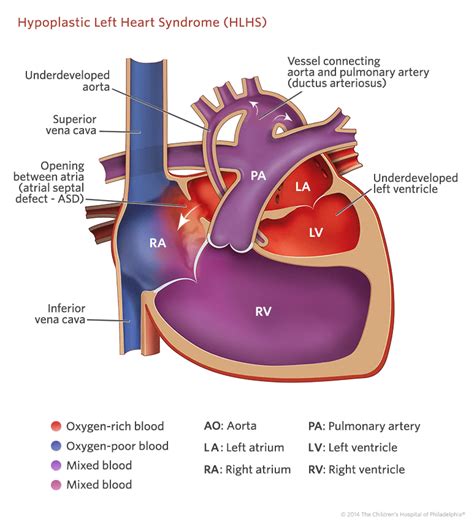 Hypoplastic Left Heart Syndrome (HLHS) | Children's Hospital of ...