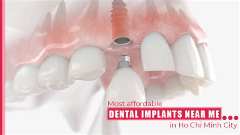 Most affordable dental implants near me in Ho Chi Minh City, Vietnam ...