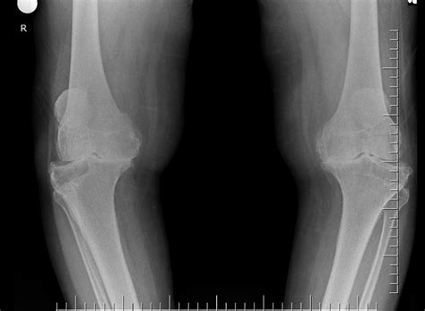 FDA clears artificial intelligence algorithm for diagnosing osteoarthritis on knee X-rays - GoFedMed