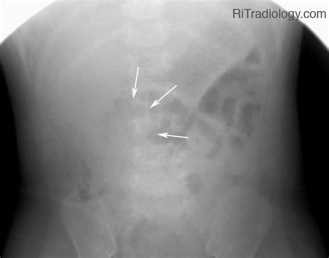 RiT radiology: Intussusception Reduction