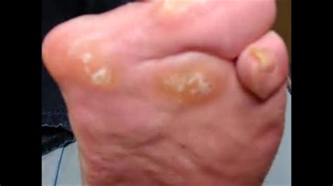 Vitamins To Help Prevent Gout - Prevent Gout Flare Ups - YouTube