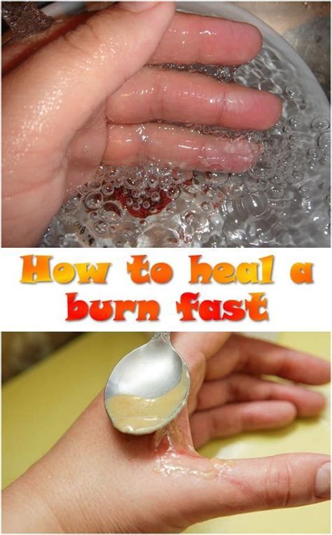 15 Effective Home Remedies to Treat Minor Burns at Home Fast in 2020 | Home remedies for burns ...