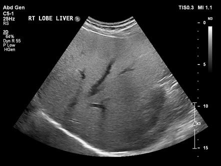 Diffuse hepatic steatosis (grading) | Radiology Reference Article | Radiopaedia.org