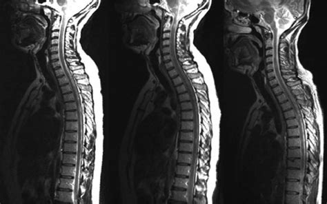 Ms Mri Brain Scan Results