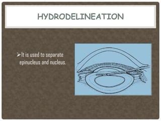 Phacoemulsification | PPT