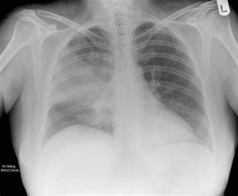 Lobar pneumonia(폐렴)의 흉부 X선 소견(Chest X-ray, CXR): lobar consolidation : 네이버 블로그