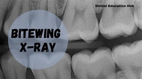 Bitewing X-ray | Intraoral Dental Radiograph - YouTube