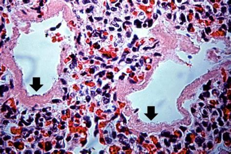 IPLab:Lab 13:Hyaline Membrane Disease - Pathology Education Instructional Resource