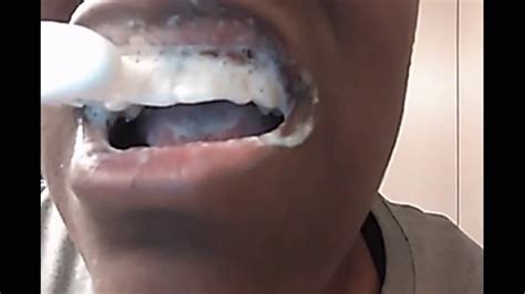 [WARNING] Teeth Whitening Baking Soda and Lemon - Bad Reaction - Before ...