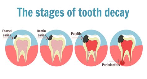 Root Canal | – Mandurah & Halls Head Dentists | Comfy Dental