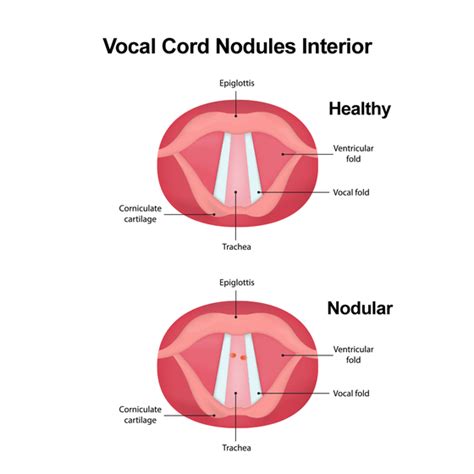 Vocal Cord Nodules - Baltimore, MD - Owings Mills, MD