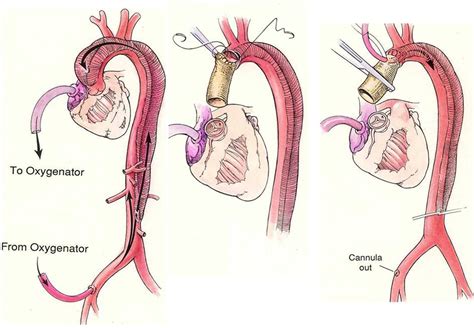 Surgery for acute type A aortic dissection - The Journal of Thoracic and Cardiovascular Surgery