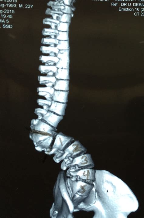 Congenital scoliosis – Jeffrey R McConnell, M.D.