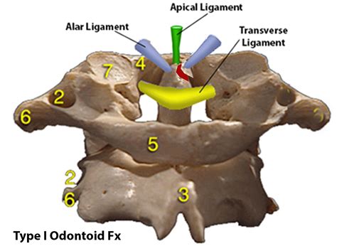 Odontoid Fracture - Spine - Orthobullets