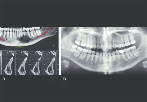 Radiographs of a biopsy-proven central giant cell granuloma of the left... | Download Scientific ...